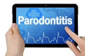 Parodontologie Krefeld - Ratgeber für Patienten